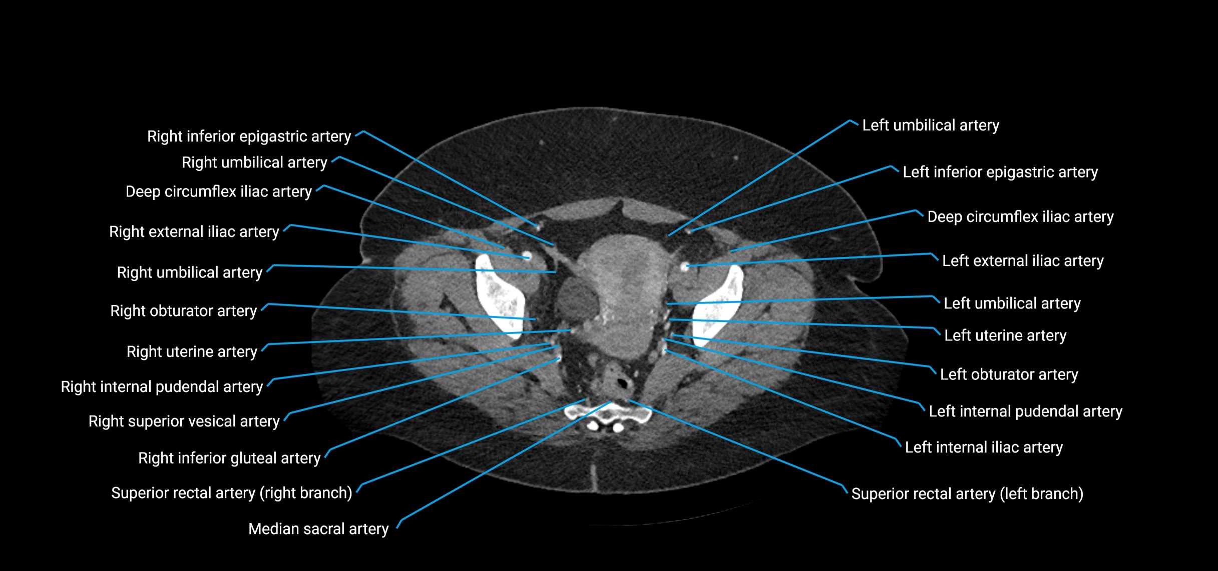 CTA abdomen axial cross sectional anatomy labelled image_222 (2).webp